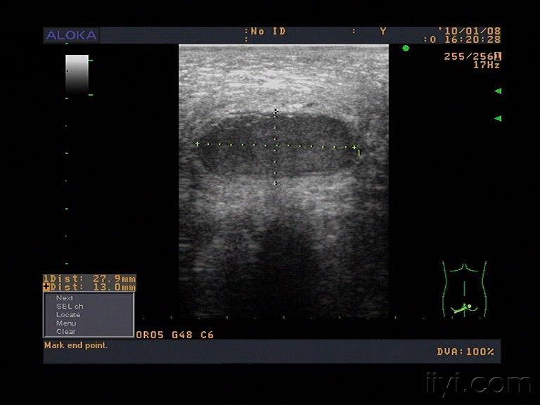 坐骨结节囊肿严重吗