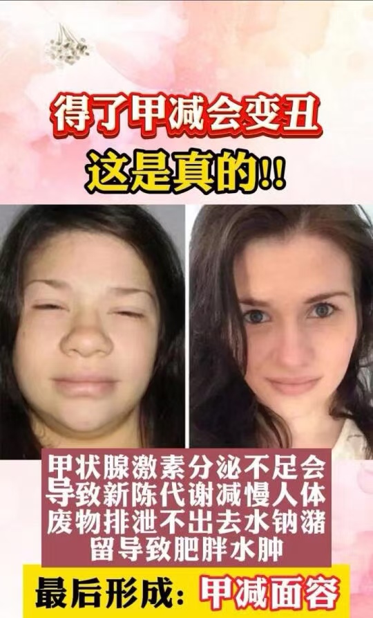 女性甲减的危害有哪些