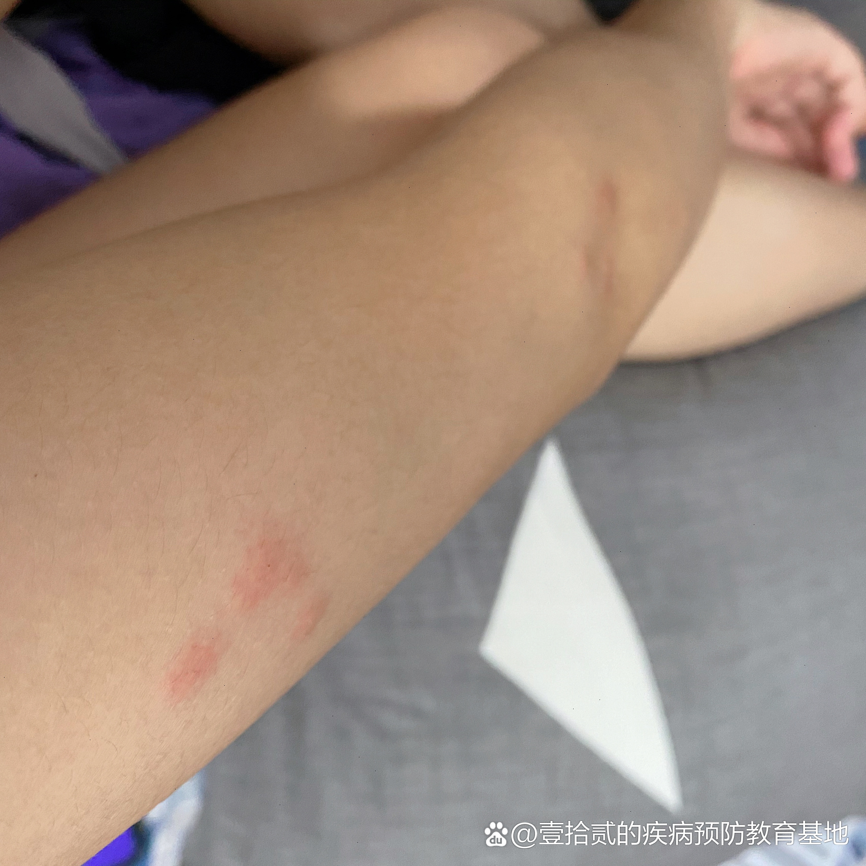 身上起红疙瘩像蚊子咬的很痒