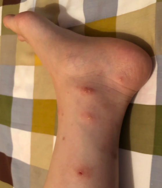 身上起红疙瘩像蚊子咬的很痒