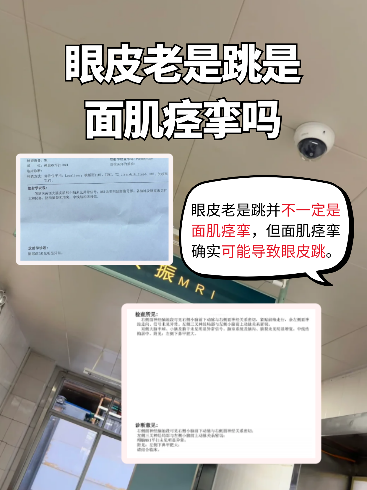 面肌痉挛的最佳治疗方法