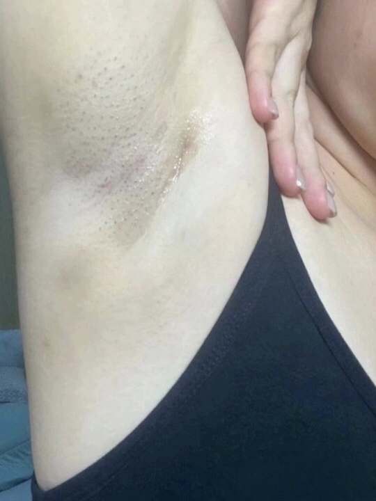 2015年2月怀孕,大概6个月发现右边腋下有副乳