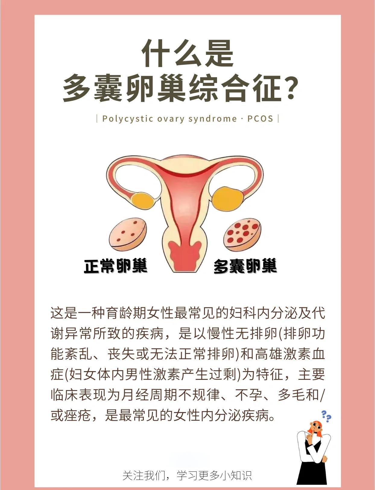 多囊卵巢综合征是什么原因导致的