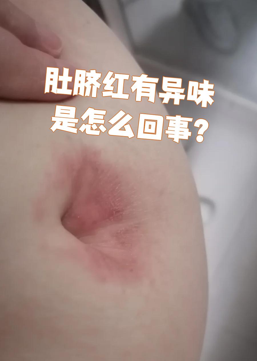 肚脐眼臭怎么回事