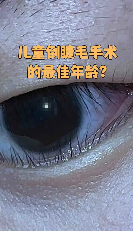 倒睫是哪些原因引起的?