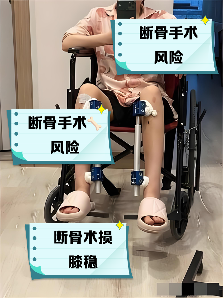 断骨增高手术可以增高多少