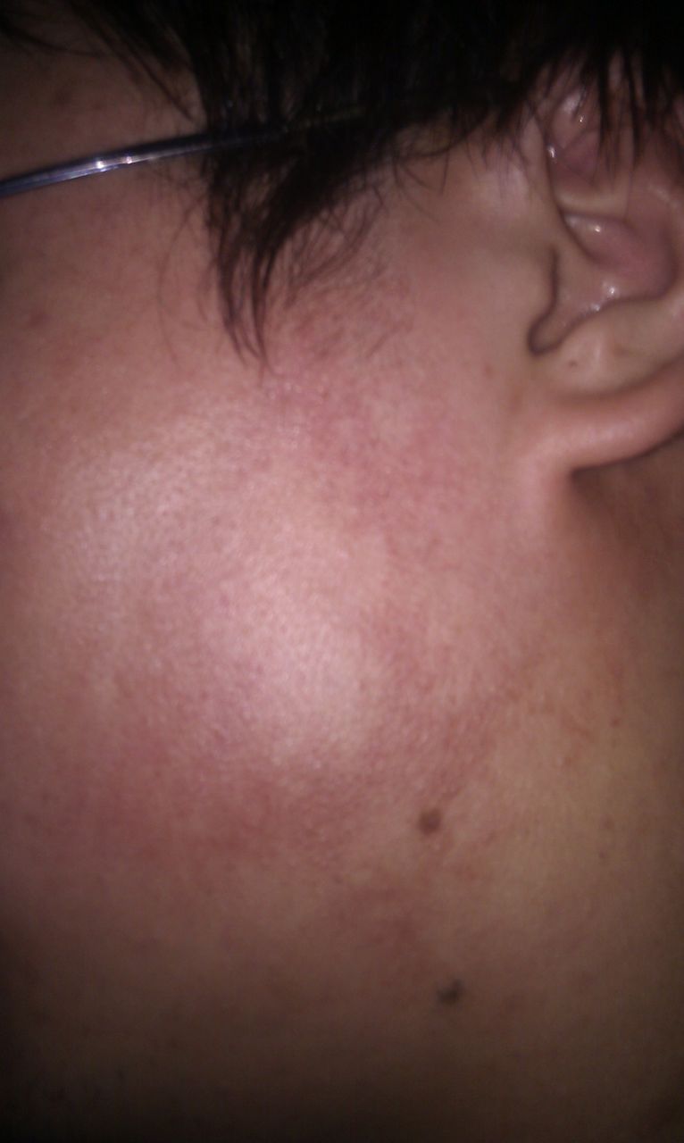 脸上出现红点,不是痘,