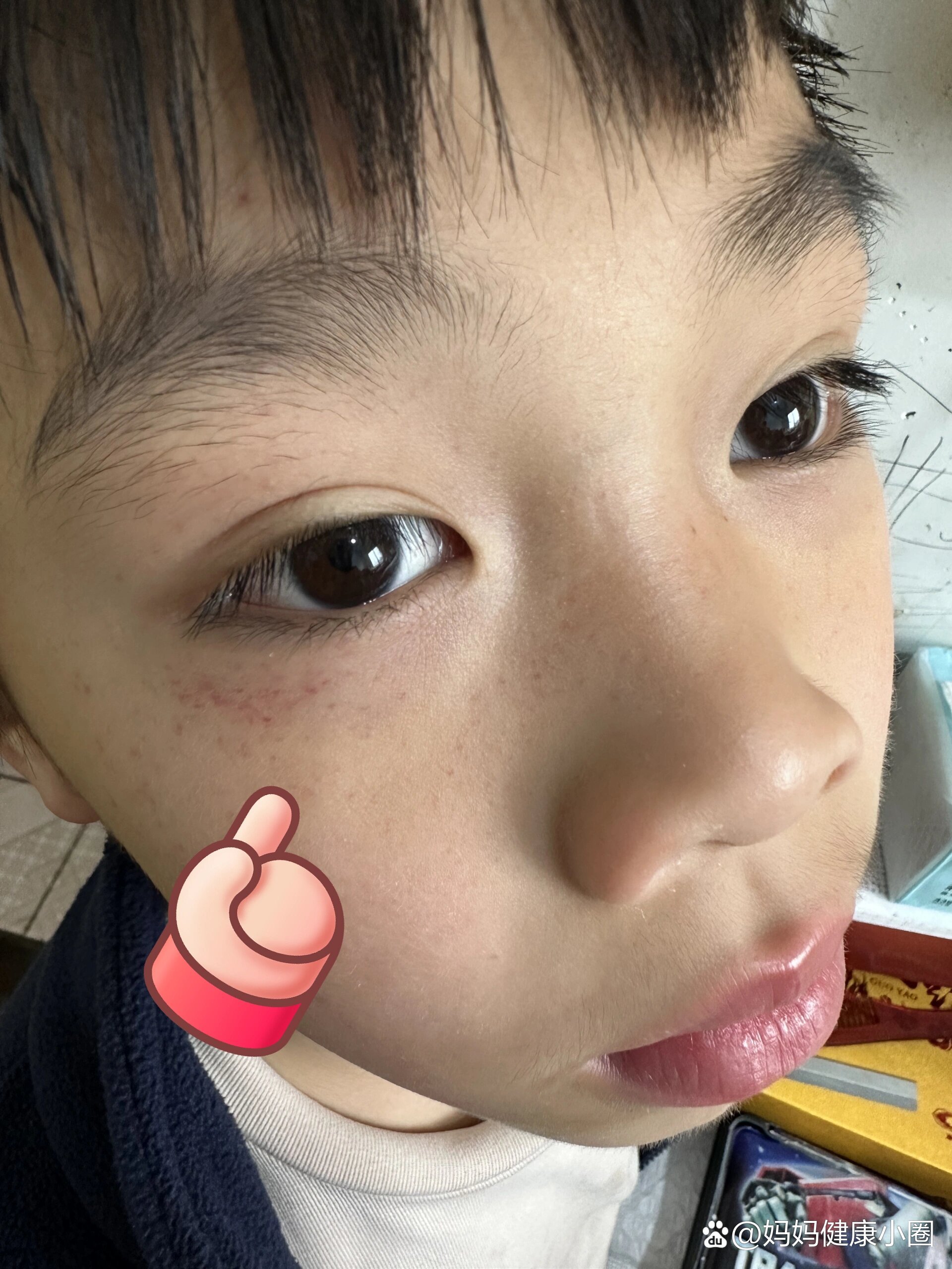 脸上出现红点,不是痘,