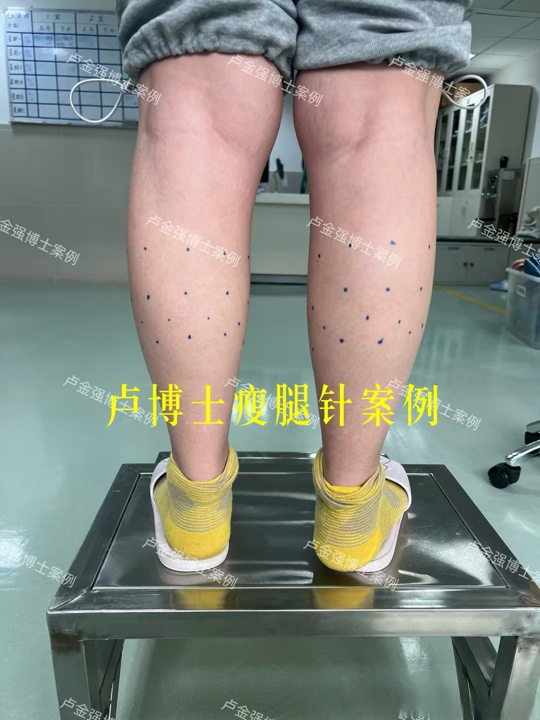 打瘦腿针有哪些副作用?