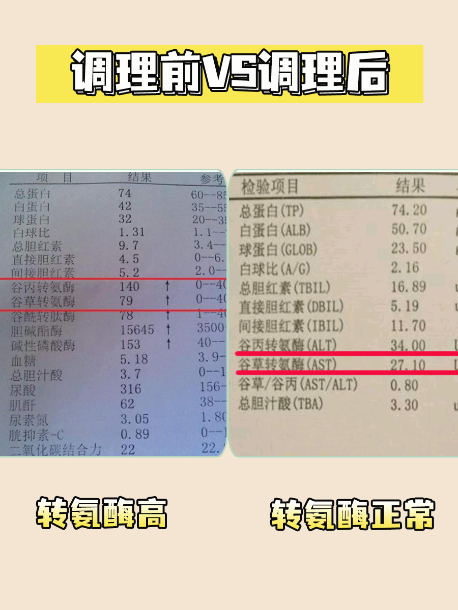 谷丙转氨酶高怎么快速降下来?