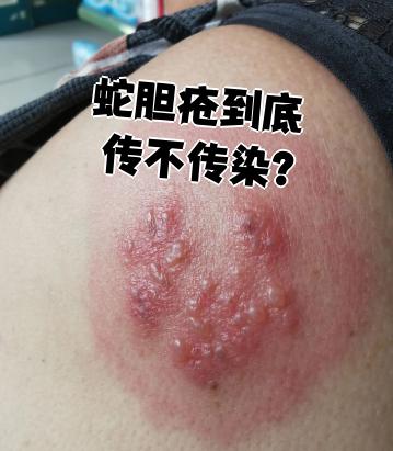 蛇缠腰是什么皮肤病