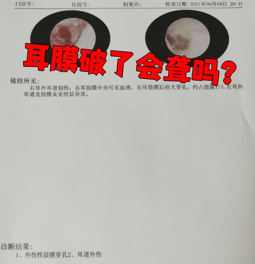 耳膜受外伤穿孔.第一张是受伤不久时的