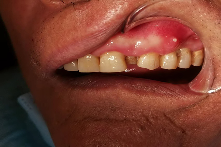 牙齿下面长了个肉疙瘩