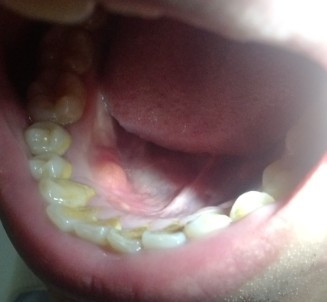 牙齿下面长了个肉疙瘩