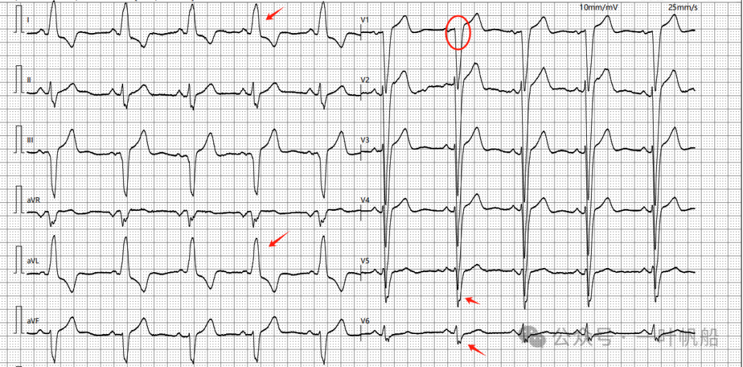 什么是左前分支传导阻滞