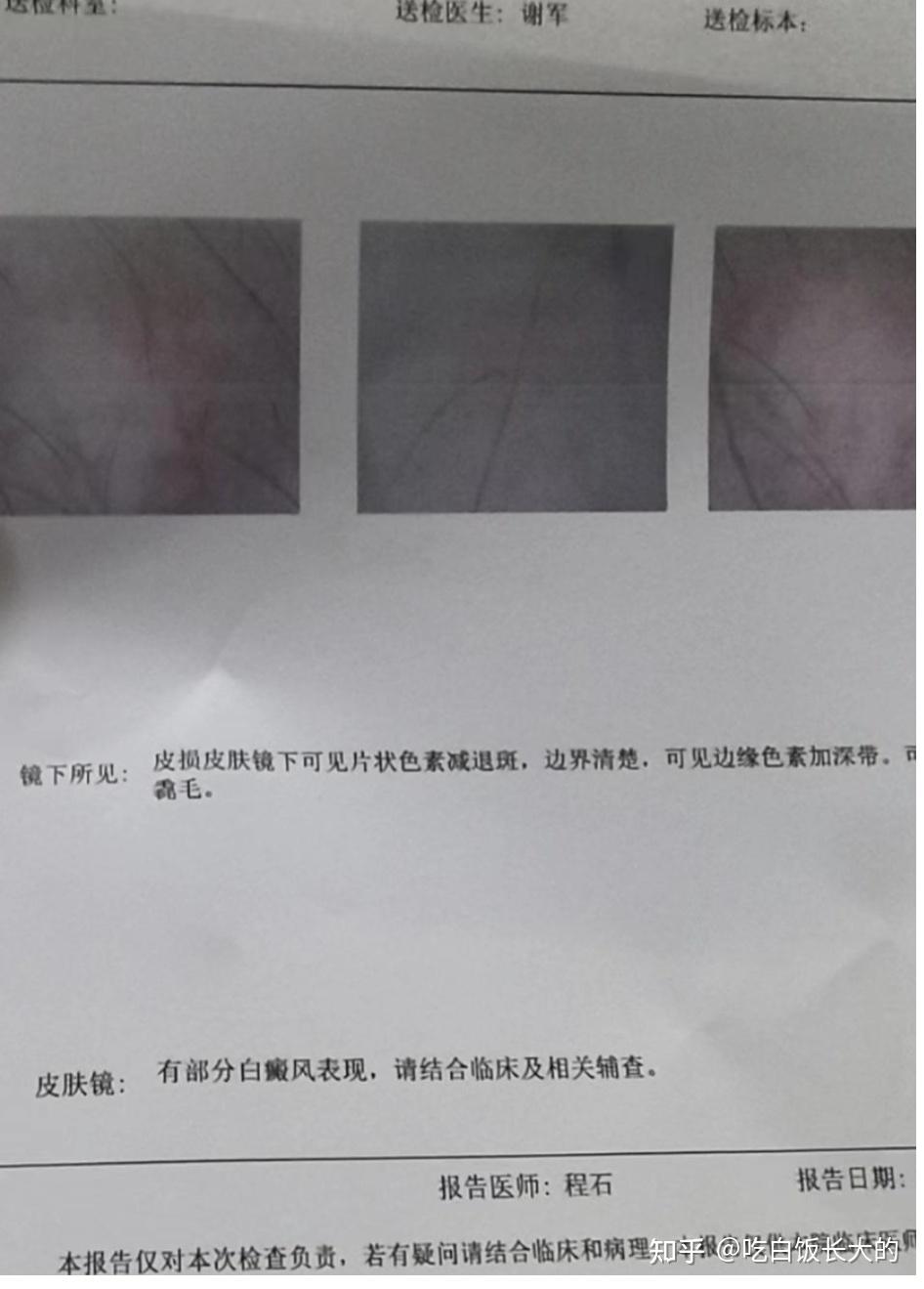 白癜风能治愈吗