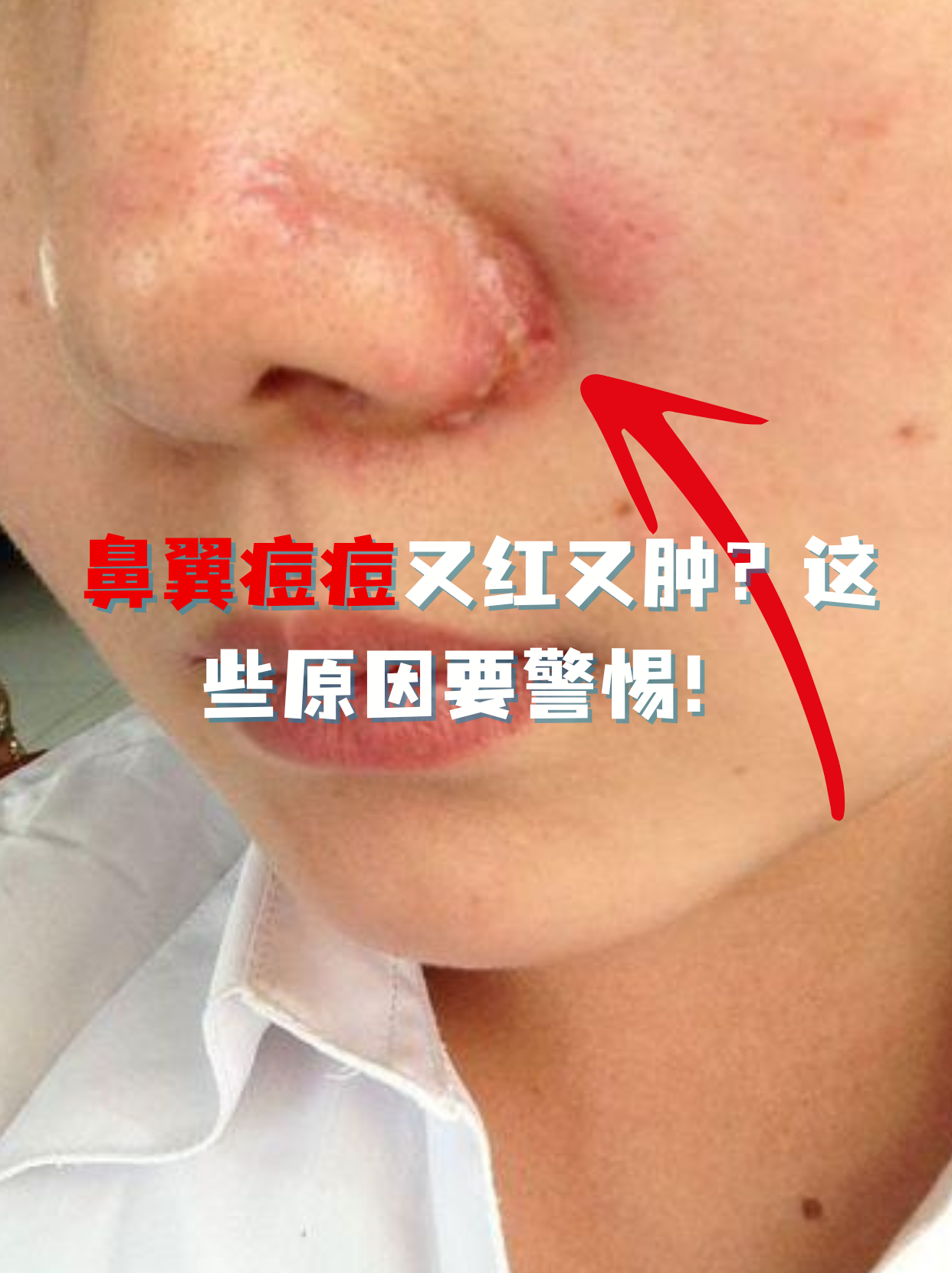 鼻翼一侧按压会痛是怎么回事