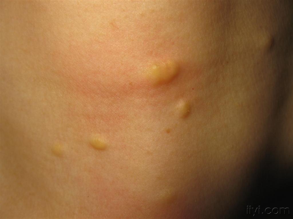 多发性脂肪瘤的症状表现?