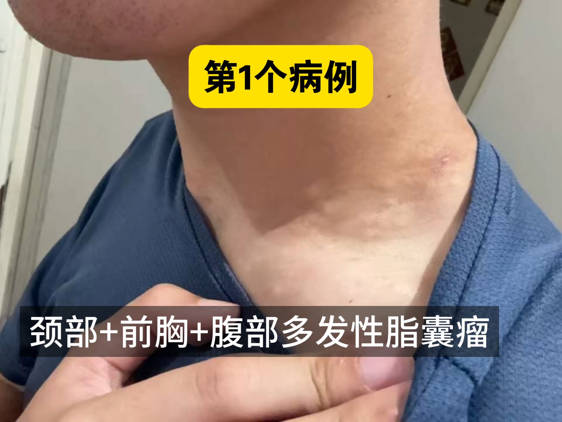 多发性脂肪瘤的症状表现?