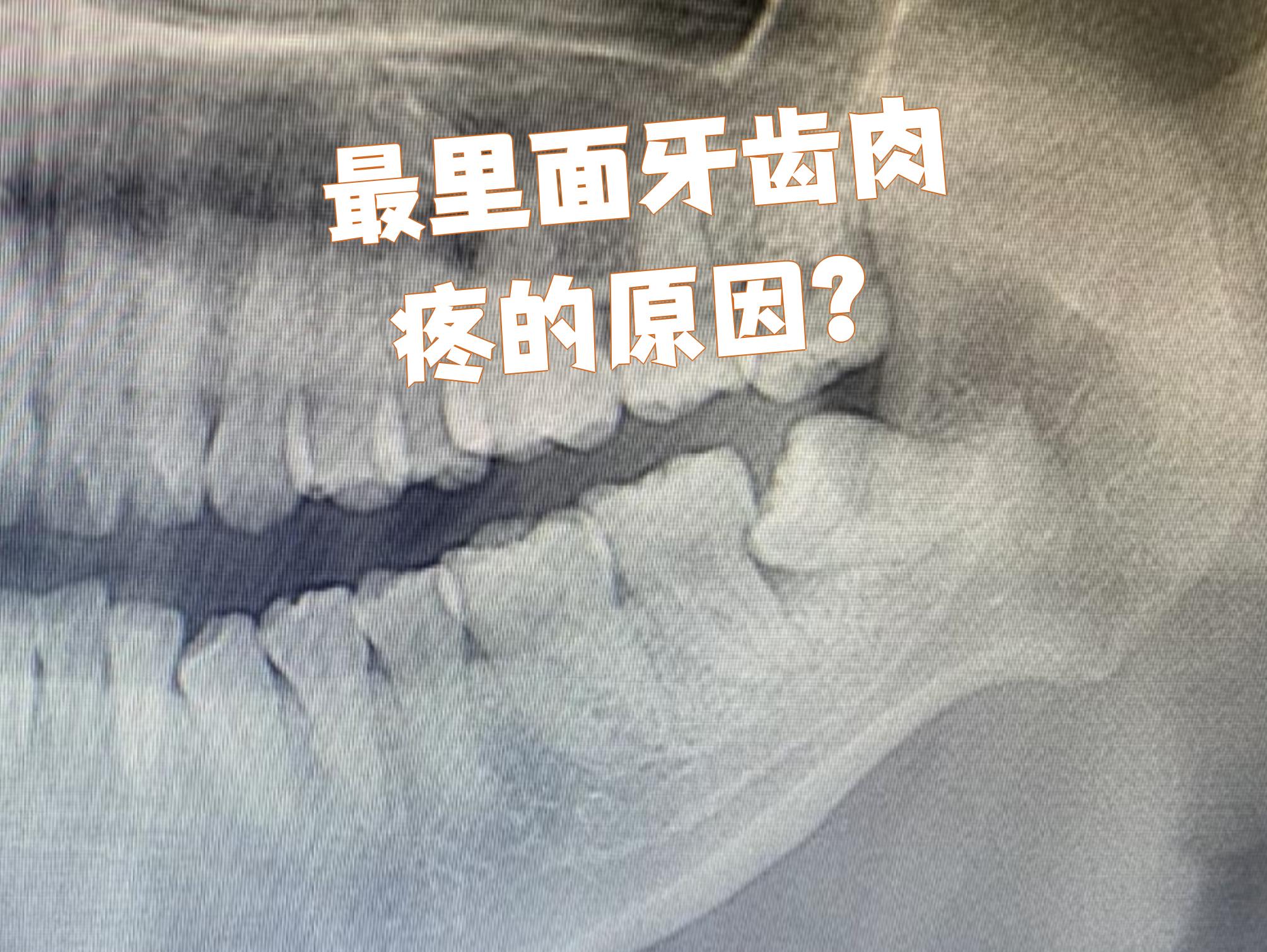 尽头牙旁边有肉长出来感觉要把牙包起来我吞口水也很痛