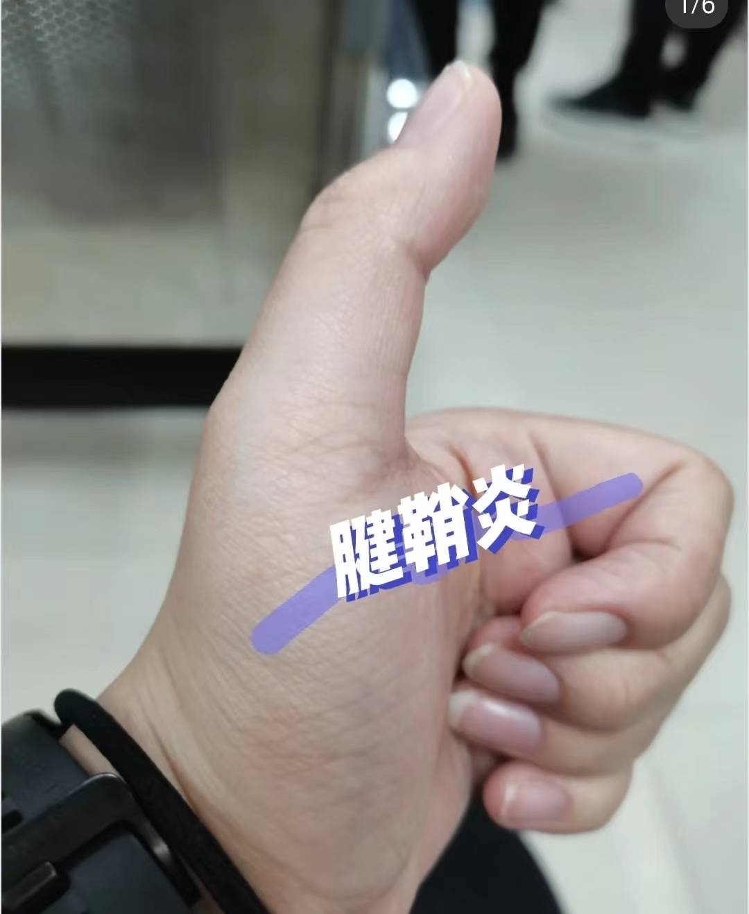 腱鞘炎的症状是什么?