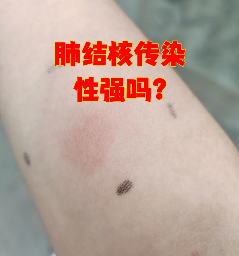 肺结核有什么样的症状表现?