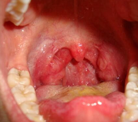 嗓子里面感觉有东西,怎么回事?