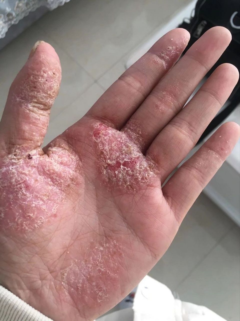 什么是掌跖脓疱病