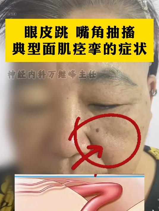 面部痉挛是什么原因引起的
