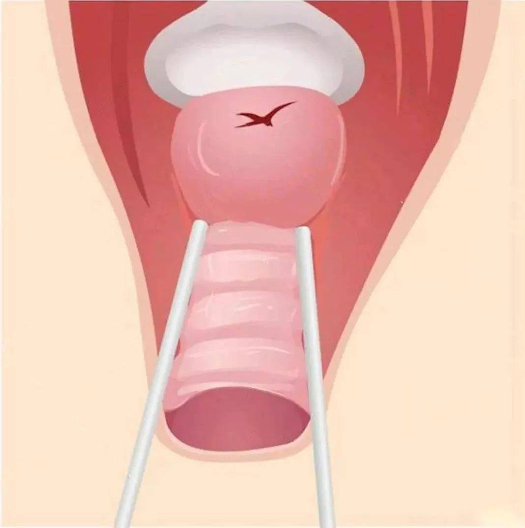 生完孩子阴道松弛怎么办