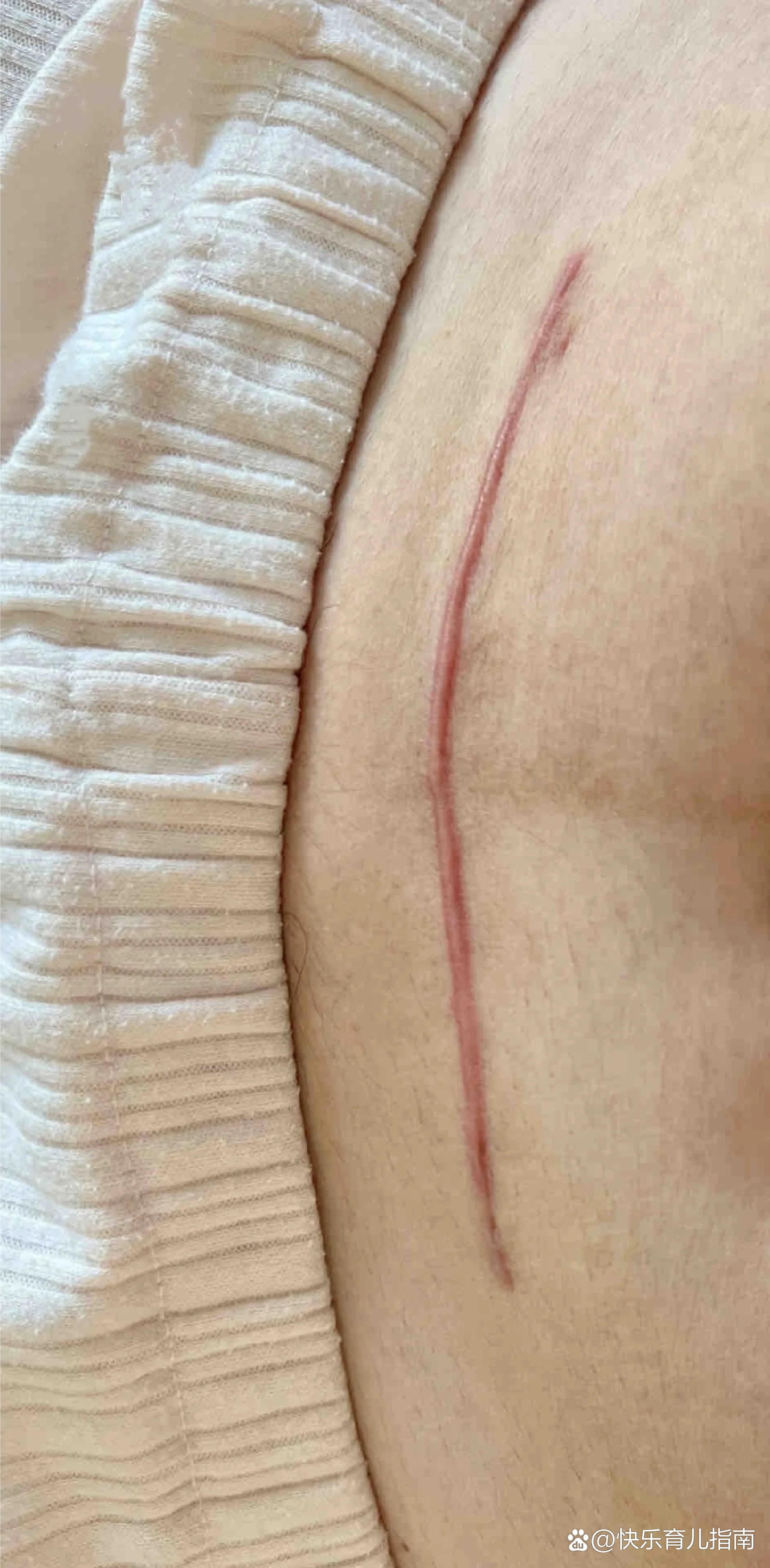 剖腹产刀口发炎初期症状