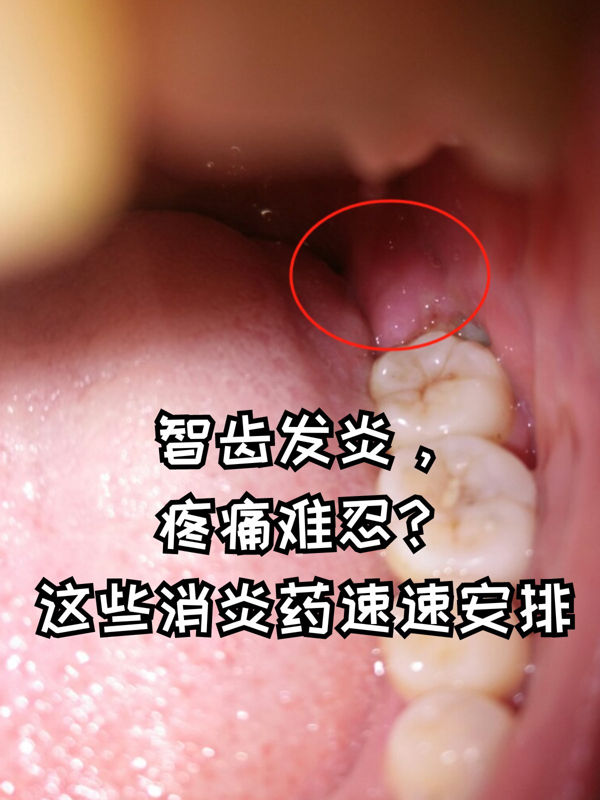 智齿发炎吃什么药