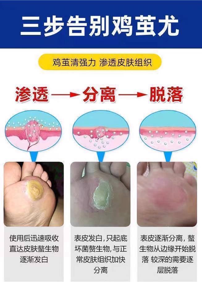 脚鸡眼怎么治才能根除