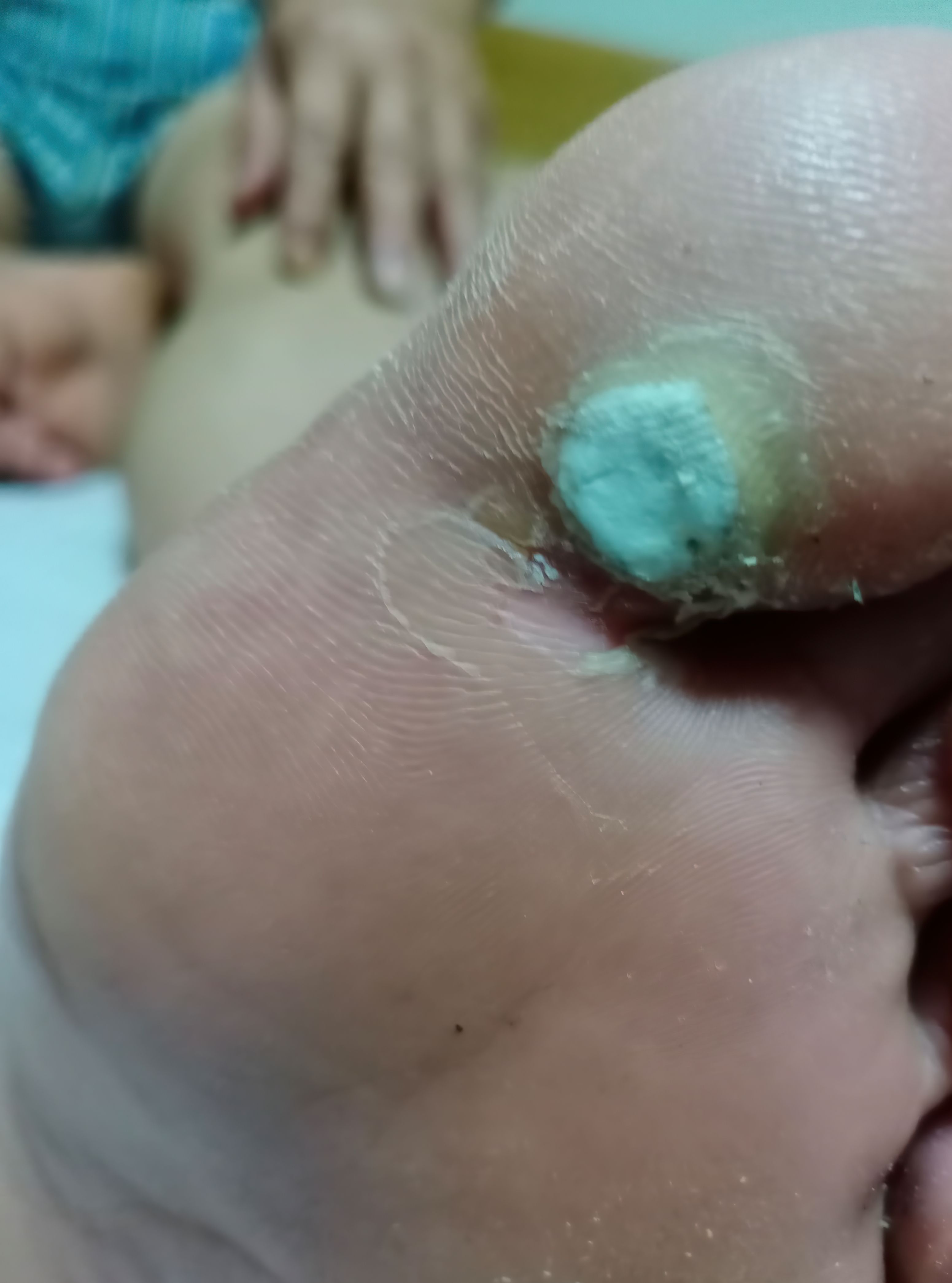 脚鸡眼怎么治才能根除