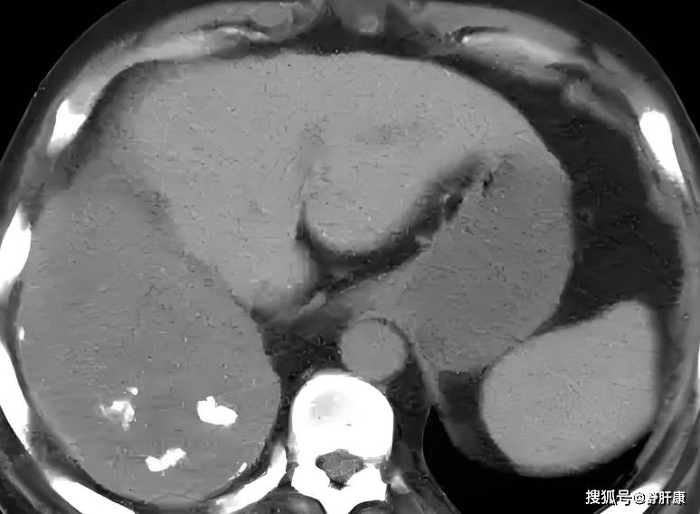 肝右叶钙化灶是什么?