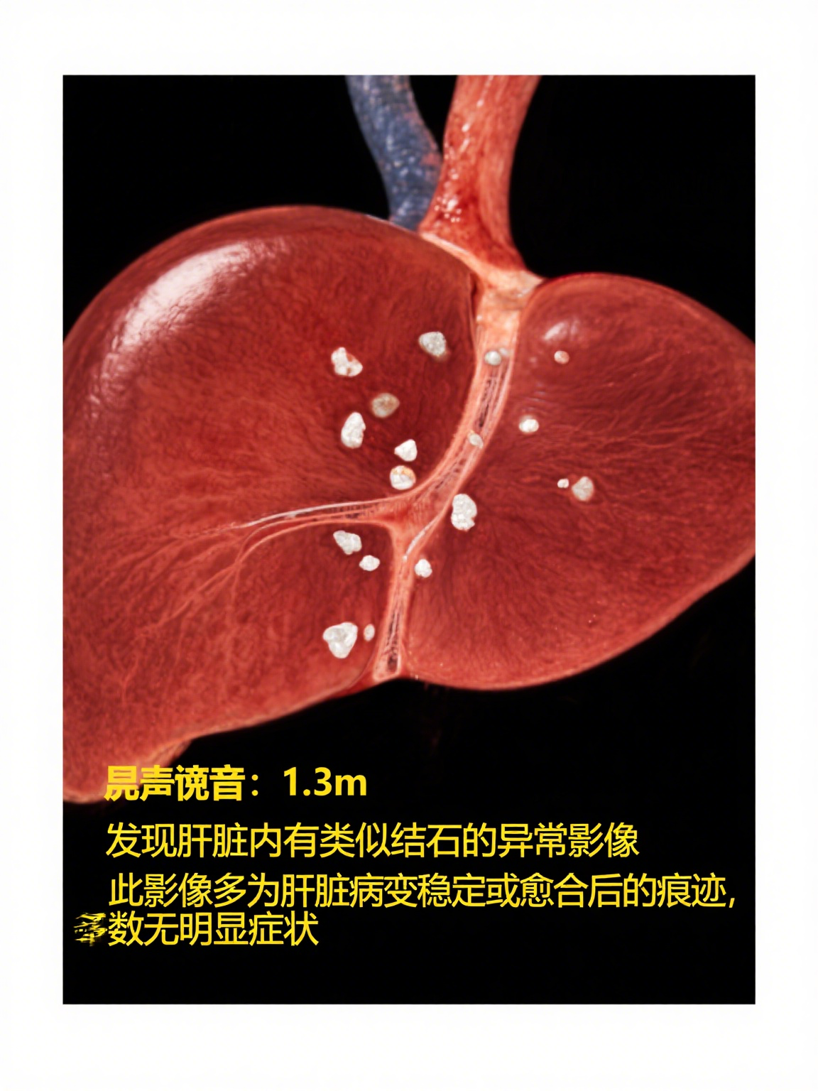 肝右叶钙化灶是什么?