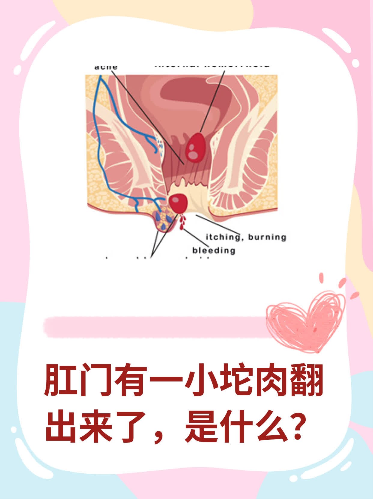 肛门旁边起了个肉疙瘩