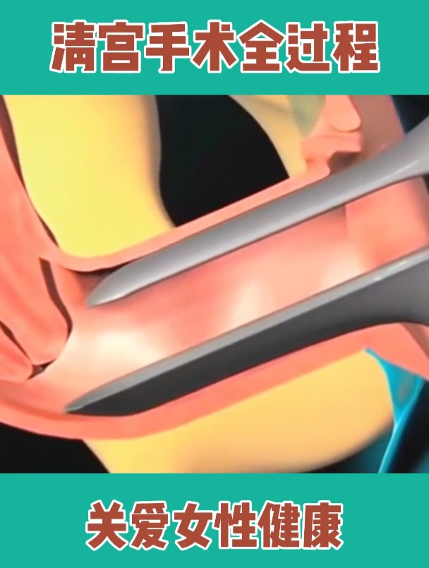人流手术过程