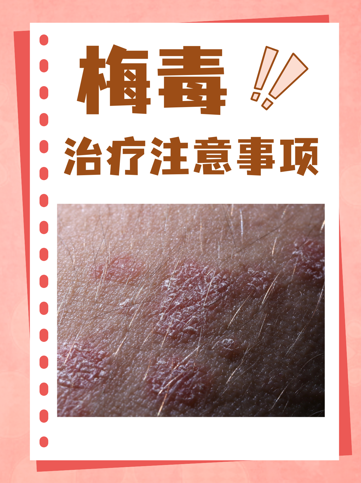 梅毒是艾滋病的一种吗?