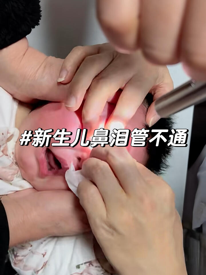 鼻泪管堵塞怎么治疗