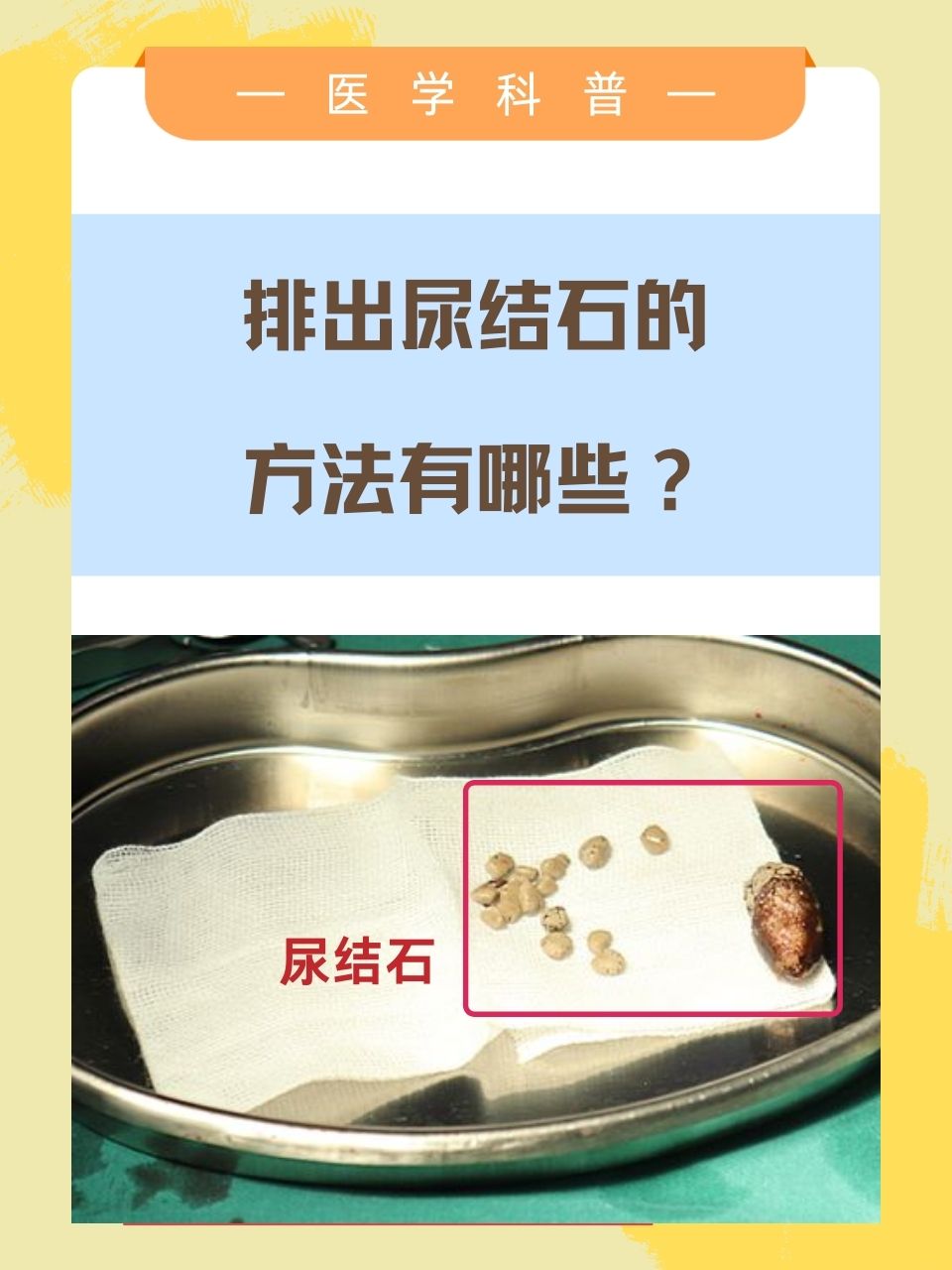 尿结石症状表现