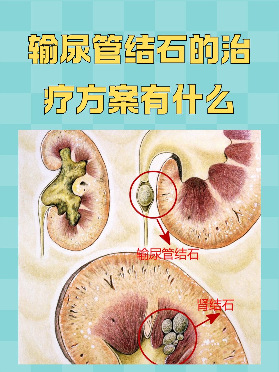 尿结石症状表现