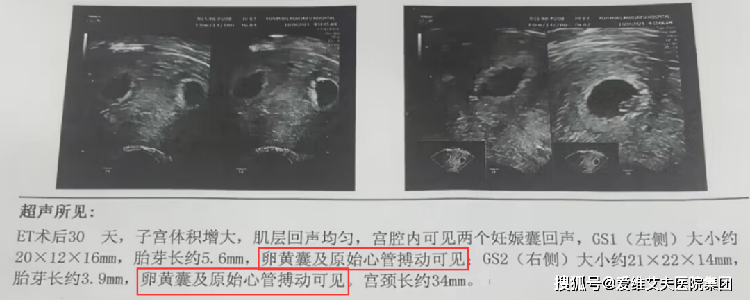 怎么样看B超单可以分出男女