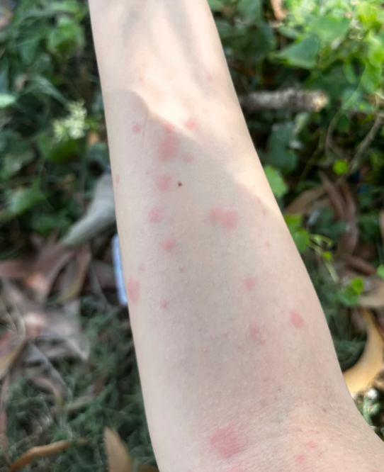 身上长红疙瘩特别痒.