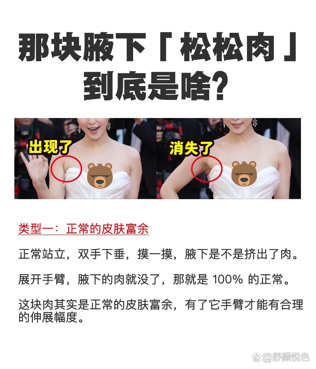 有副乳怎么消除