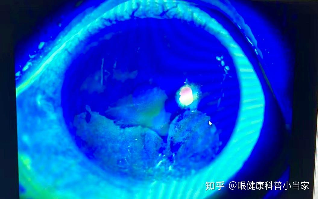 眼睛里面进胶水怎么办