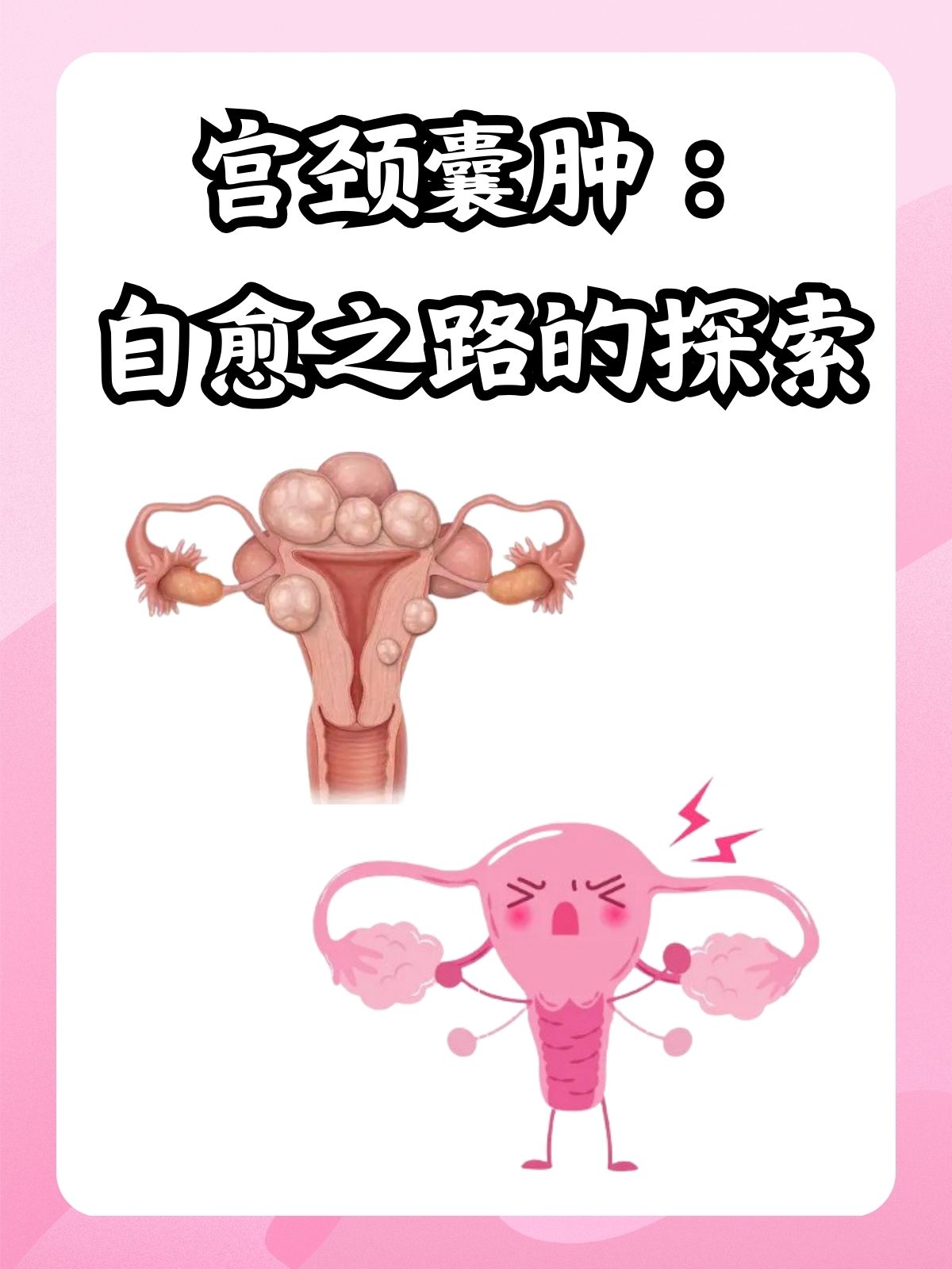 宫颈囊肿多大要做手术