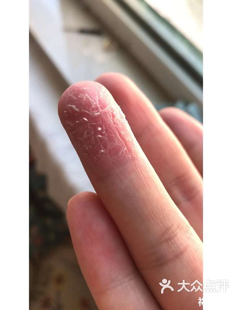 手指肚剥皮怎么回事