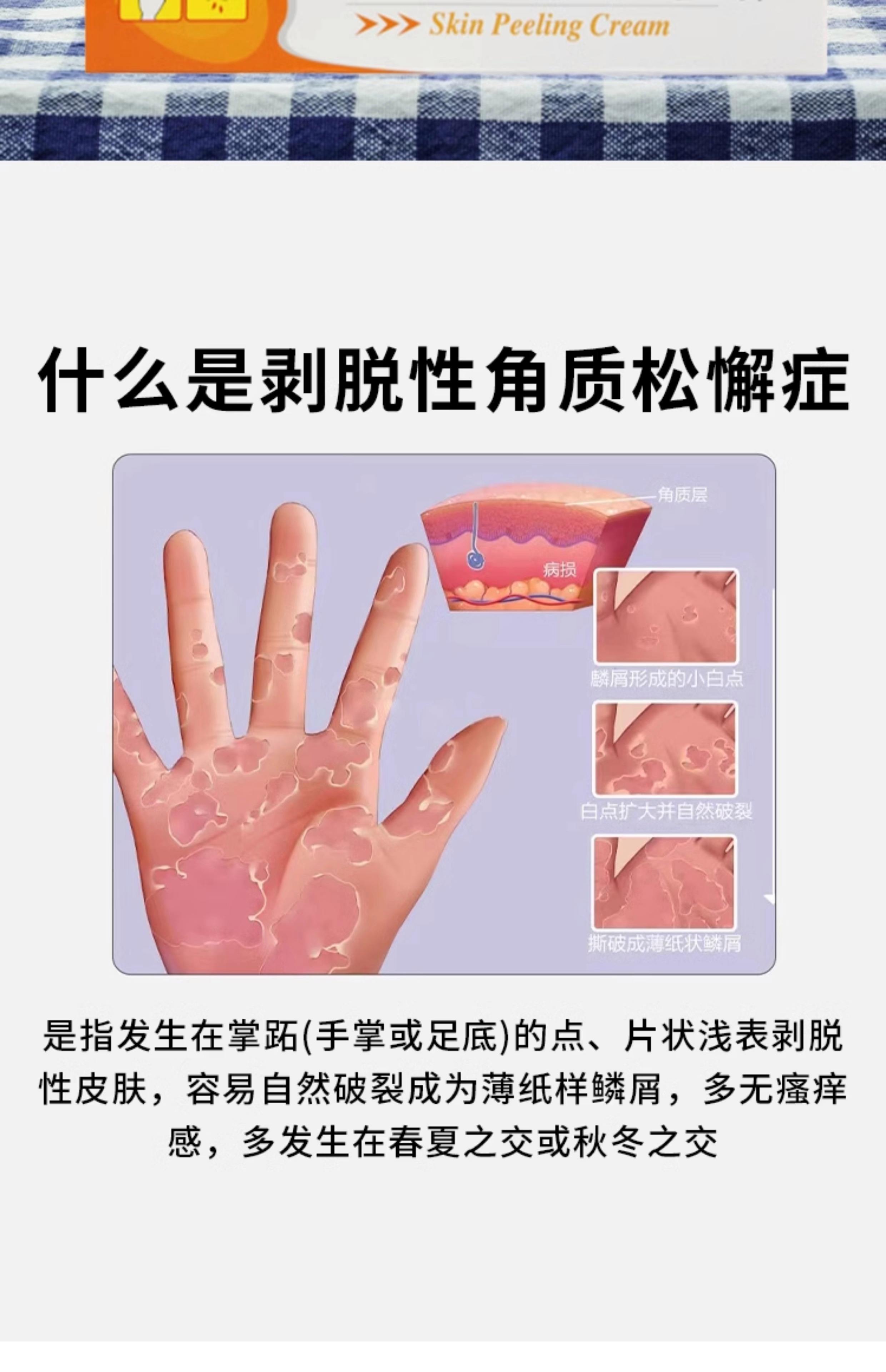 手指肚剥皮怎么回事