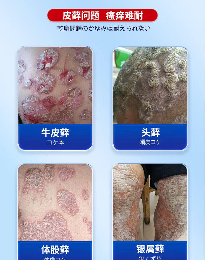 治疗牛皮癣特效偏方